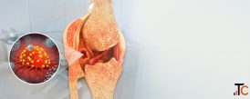 Bone Cancer Hospital in Delhi