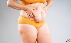 Tummy Tuck Surgery in Delhi - Dr Rajat Gupta