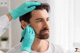 Why Fly to Turkey When World-Class Hair Transplant Is Right Here