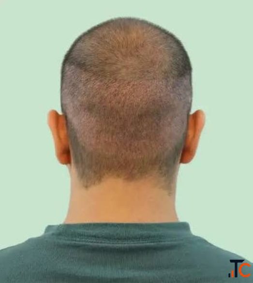 Get Smooth Scalp Fuller Hair with The Botox Hair Treatment