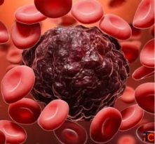 Blood Cancer Specialist in Hyderabad