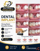 Get Your Smile Back - Painless Flapless Dental Implants