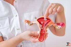 Fibroid Prevention Tips to Reduce the Risk of Uterine Fibroids