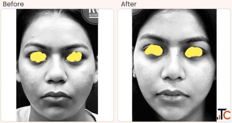 Buccal Pad Fat Removal Surgery in Delhi - Dr Rajat Gupta