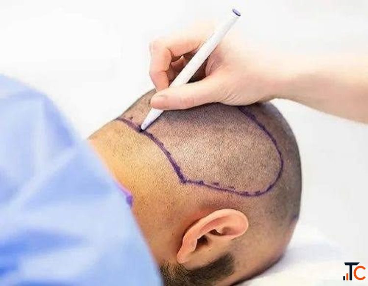 Noida's Most Trusted Destination for Hair Restoration Is Here
