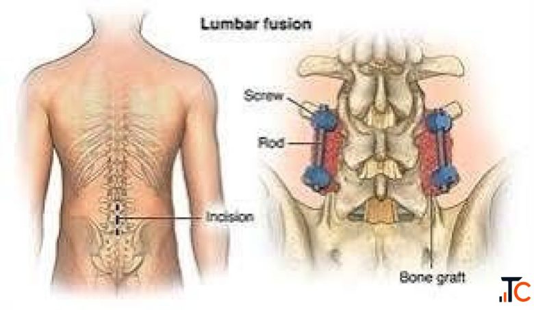 Lumbar Spinal Stenosis Treatment in Gurgaon Effective Treatment for Professional Physiotherapists