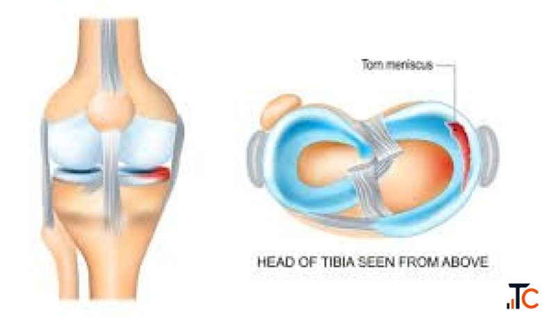 Meniscus Injury in Gurgaon Repairing Mobility using the highest level of precision