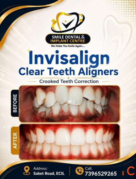 INVISALIGN CLEAR ALIGNERS at Smile Dental Implant Centre