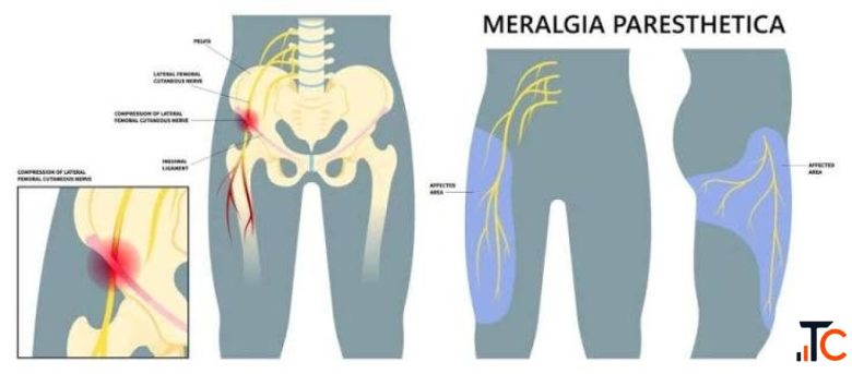 Meralgia Paresthetica Treatment in Gurgaon Expert Physiotherapists in Gurgaon