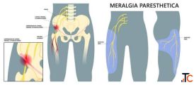 Meralgia Paresthetica Treatment in Gurgaon Expert Physiotherapists in Gurgaon