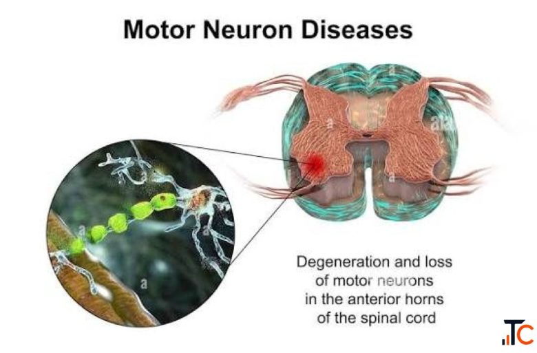 Motor Neuron Disease Treatment in Gurgaon Expert Physiotherapy Services for Motor Neuron Disease