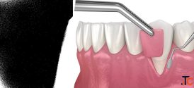 Advanced Gum Care at Agrawal Dental Clinic