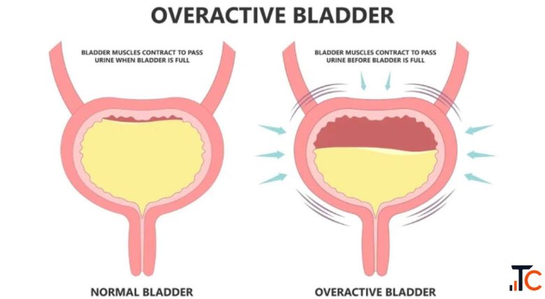 Overactive Bladder Treatment in Pune Dr. Rakshit Ahuja