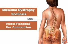 Muscular Dystrophy Treatment in Gurgaon effective physiotherapy treatment to patients
