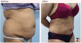 Liposuction Surgery Cost in delhi - Dr Rajat Gupta