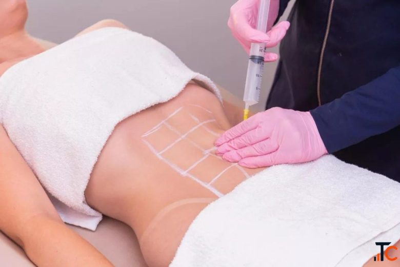 Does VASER Liposuction Actually Tighten Skin