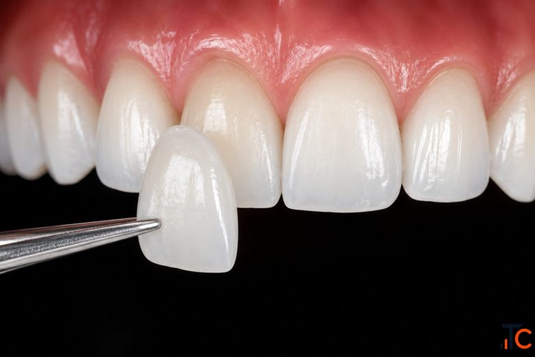 Dental Veneers in Chintal Veneer Treatment Dantam Dental