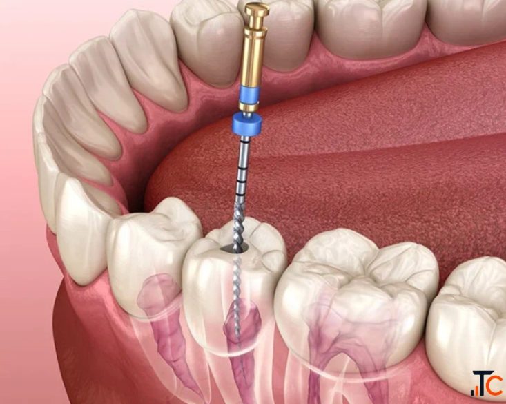 Reliable Root Canal Treatment for Damaged Teeth The Dental Wellness Centre