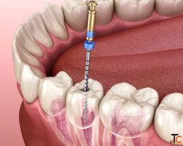 Reliable Root Canal Treatment for Damaged Teeth The Dental Wellness Centre