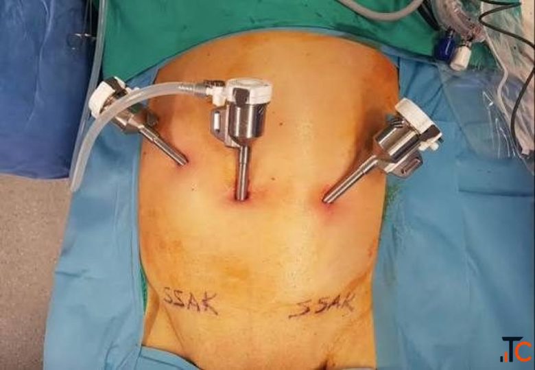 Hiatal Hernia Surgery in Delhi - Advanced Treatment