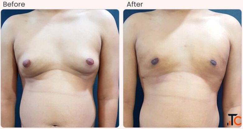 Gynecomastia Surgery Cost in Delhi - Dr Rajat Gupta