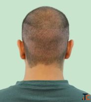 Stop Hair Loss Before It Stops You with Expert Treatment in Delhi
