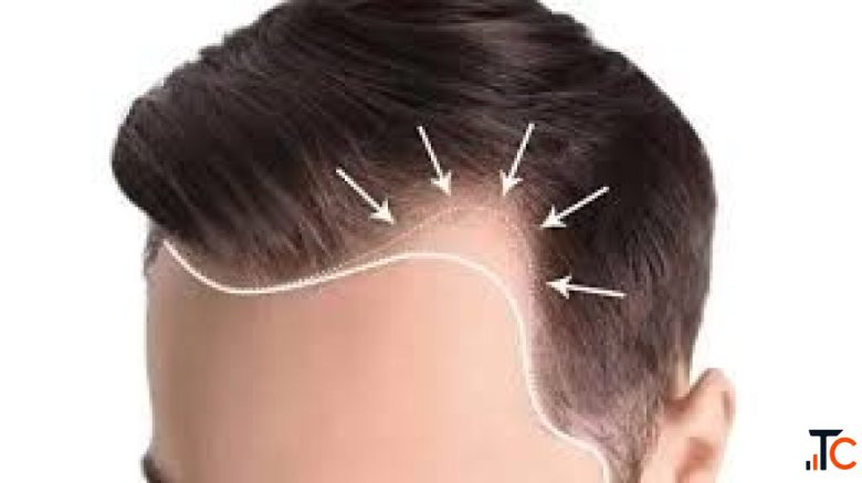Stop Hair Loss Before It Stops You with Expert Treatment in Delhi