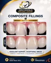 Chipped or Decayed Front Teeth Get Invisible Fillings at Smile Dental