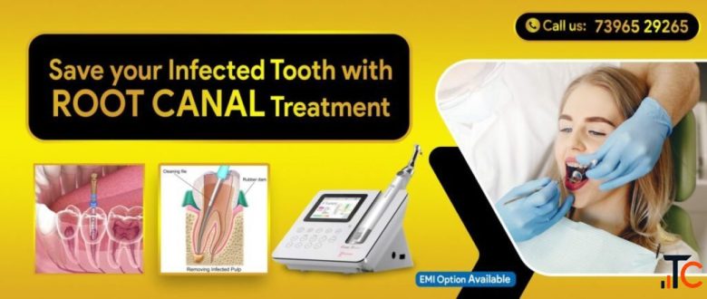 Painless Root Canal Treatment for Sainikpuri Residents