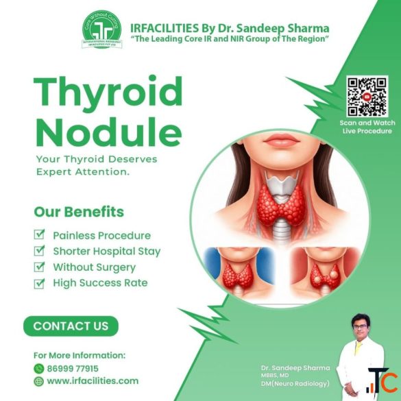 Thyroid Nodule Treatment in India without Surgery - Modern Approach